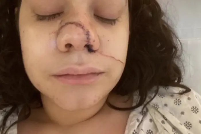 The victim of a recent slashing, seen in a photo showing a large scar across her nose.